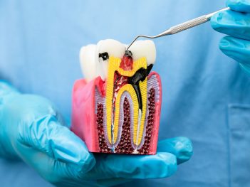 A dentist explaining a root canal procedure