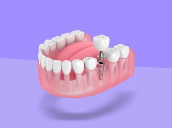 A Set Of Teeth Implants Miami.