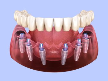 Dental Implants in Miami