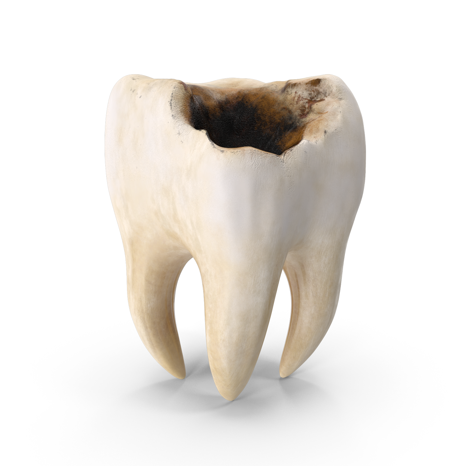 broken-tooth-miami-dental-sedation-spa-