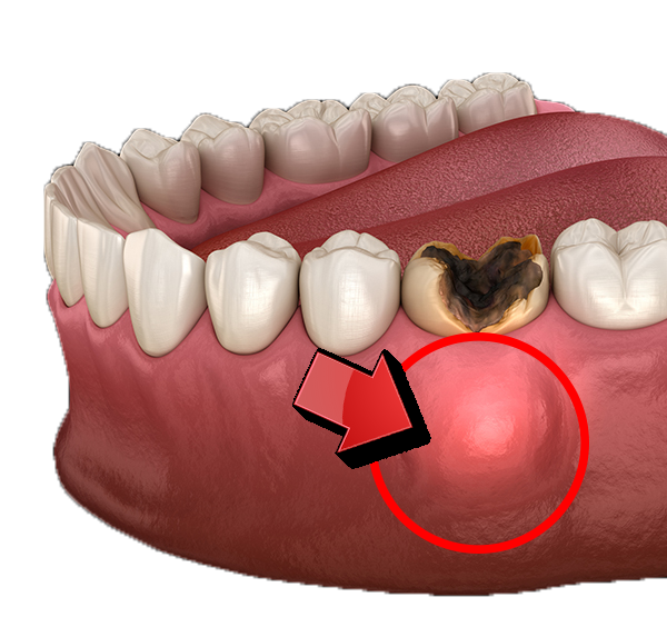 dental-abcess-miami-dental-sedation-spa A Dental Abcess