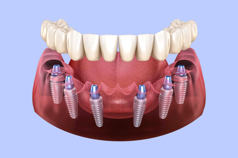Dental Implants in Miami