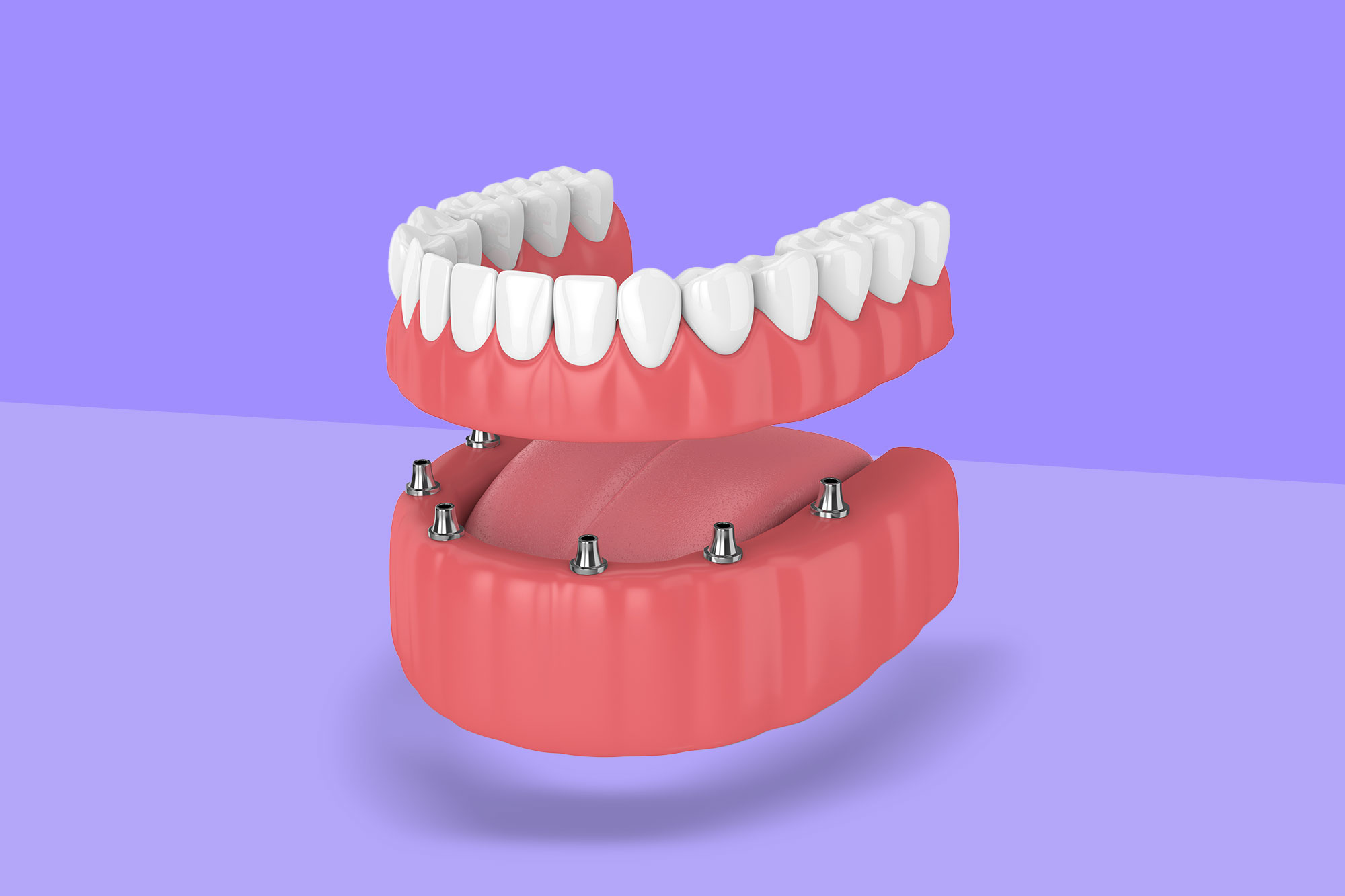 Hybrid Dentures A Set Of Teeth Implants Miami.