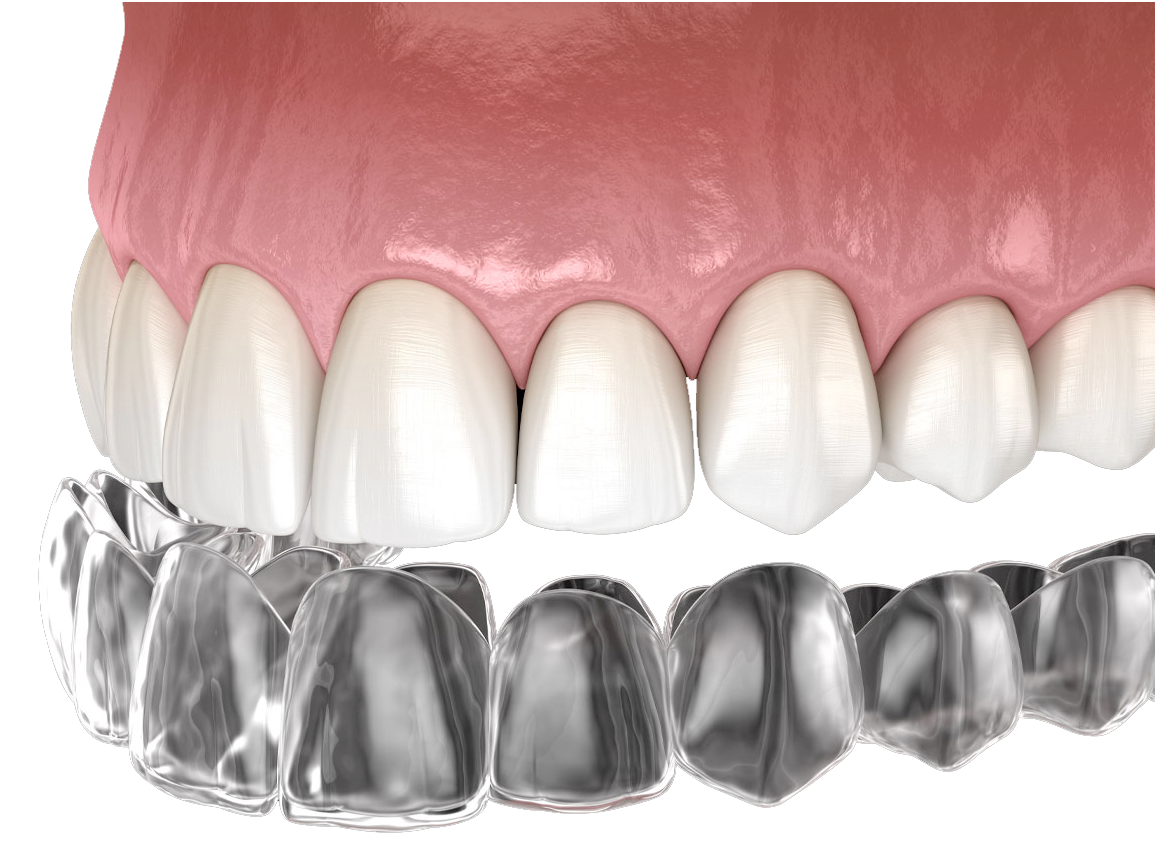 Invisalign Miami
