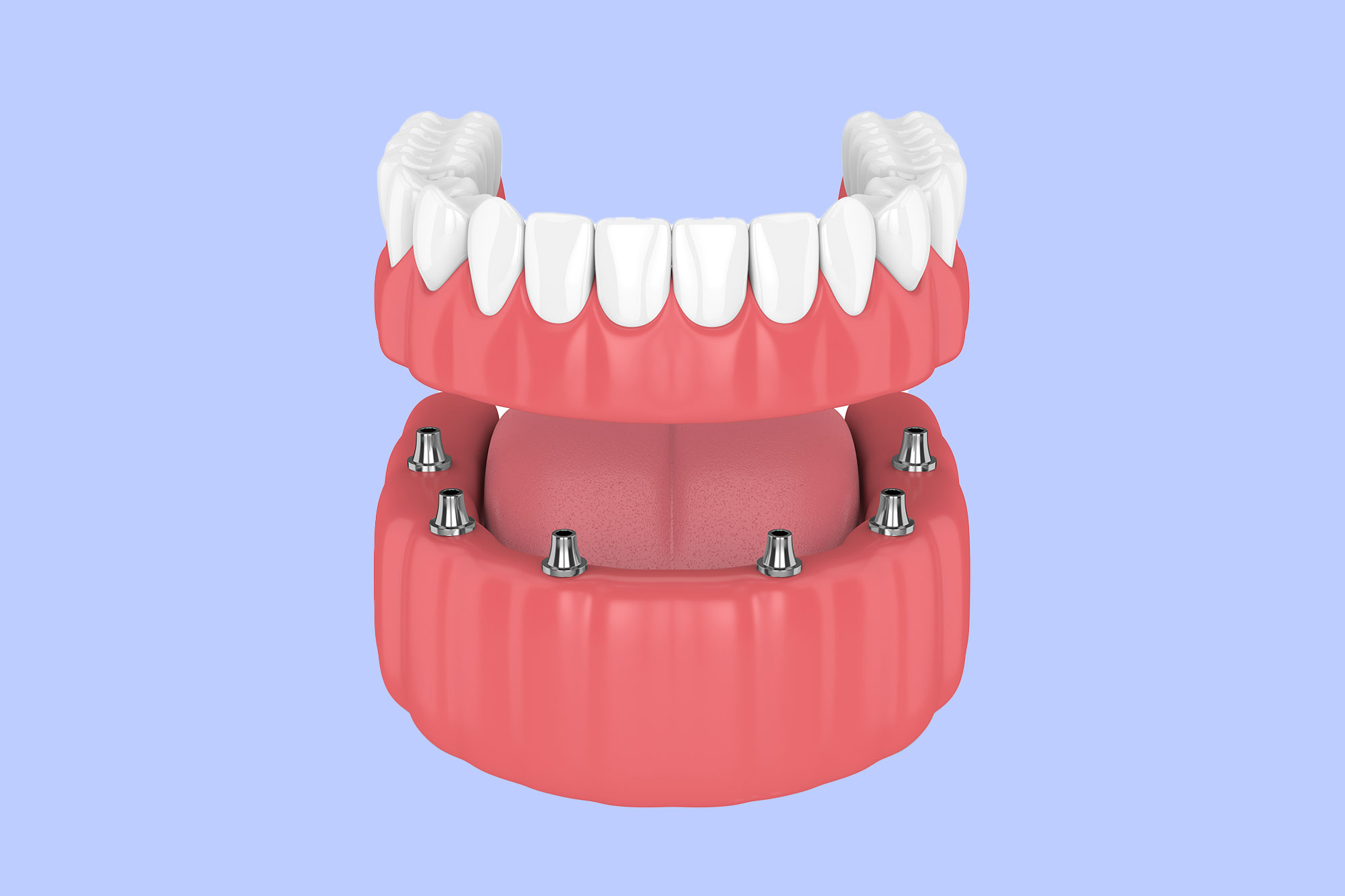 all-on-x-dental-implants-miami All-On-X Dental Implants