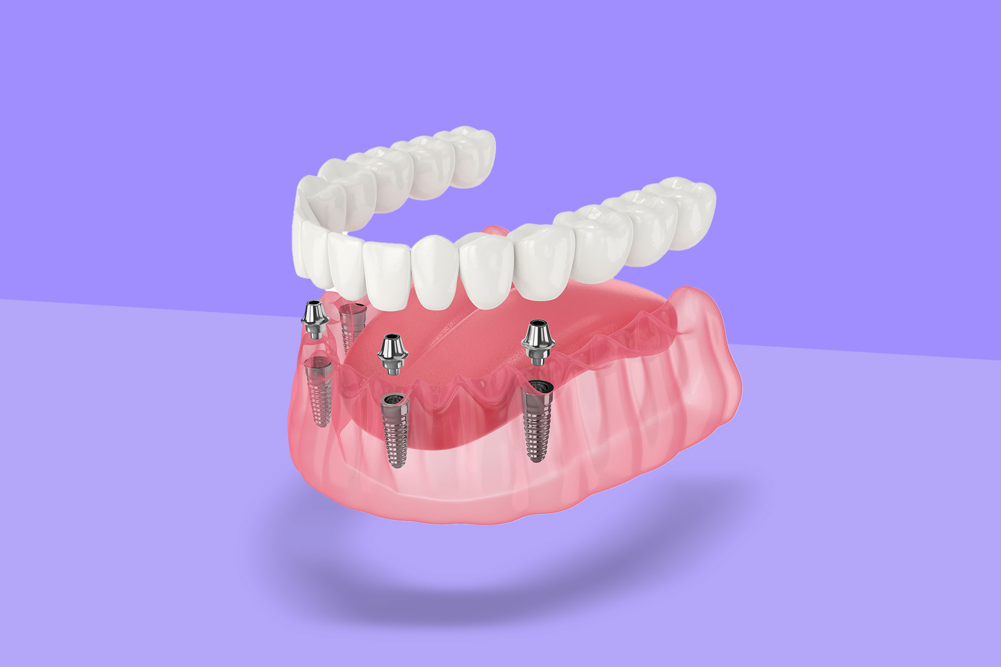 A Set Of Teeth Implants Miami.