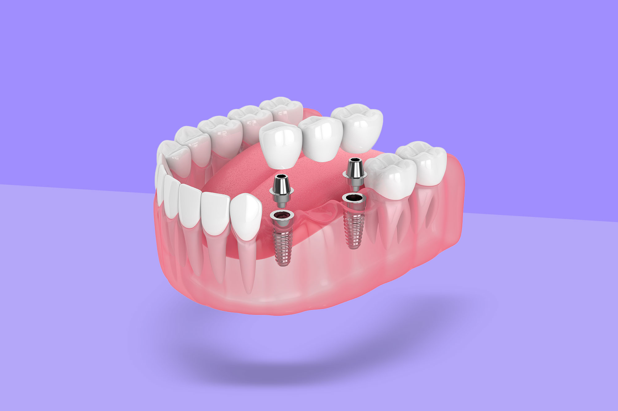 A Set Of Teeth Implants Miami.