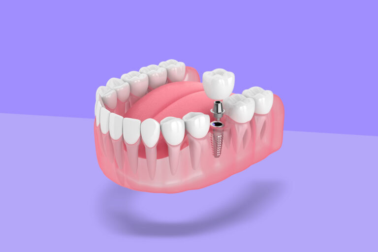 A Set Of Teeth Implants Miami.