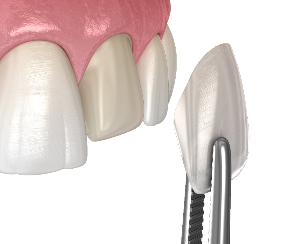 Cosmetic Veeners Miami