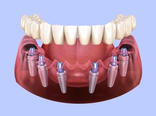 Dental Implants in Miami