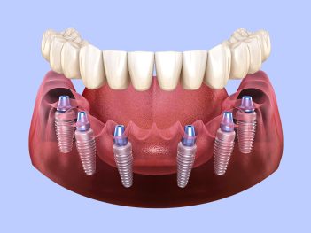 All-on-x-dental-implants Dental Implants in Miami