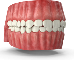 Gum-Contouring-Miami