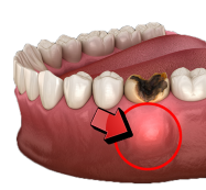 A Dental Abcess