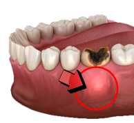 dental-abcess-miami-dental-sedation-spa A Dental Abcess