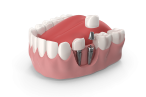 dental-implants-miami