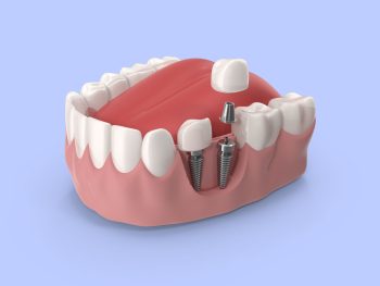 Dental Implants Miami