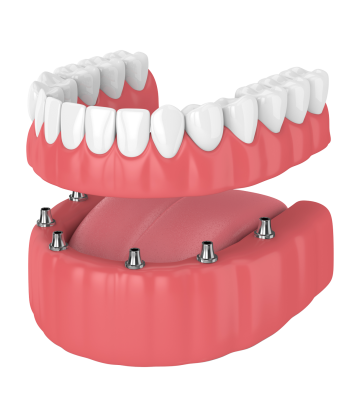 dental-implants-miami-all-on-x All On X Dental Implants Miami