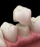 perfect-crowns dental crowns miami