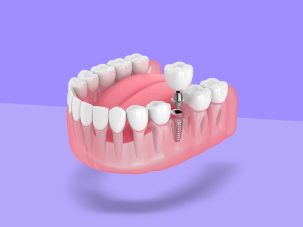 A Set Of Teeth Implants Miami.