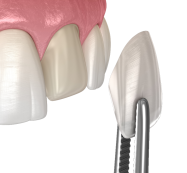 Cosmetic Veeners Miami