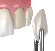 veneers-miami-dental-sedation-spa Cosmetic Veeners Miami
